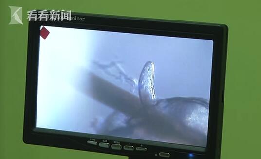 医生通过电子显微镜在徐先生的眼睫毛内发现了大量寄生的螨虫