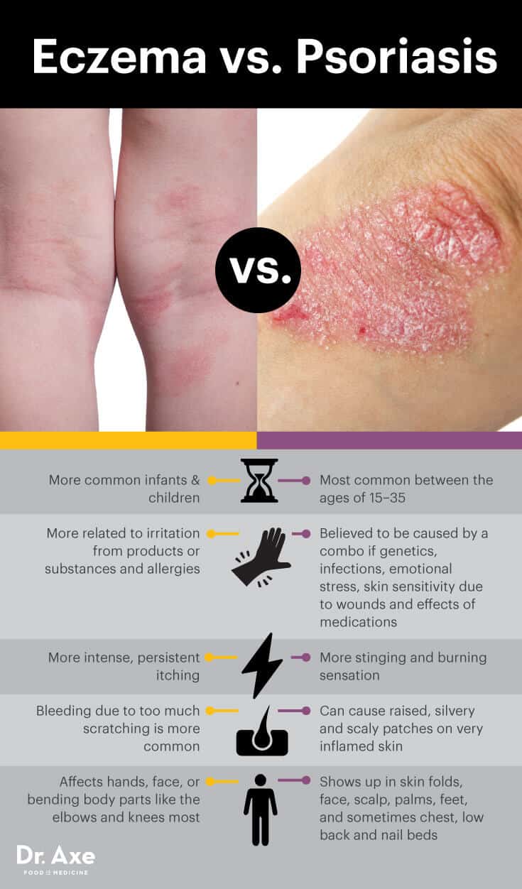 Eczema vs. psoriasis - Dr. Axe