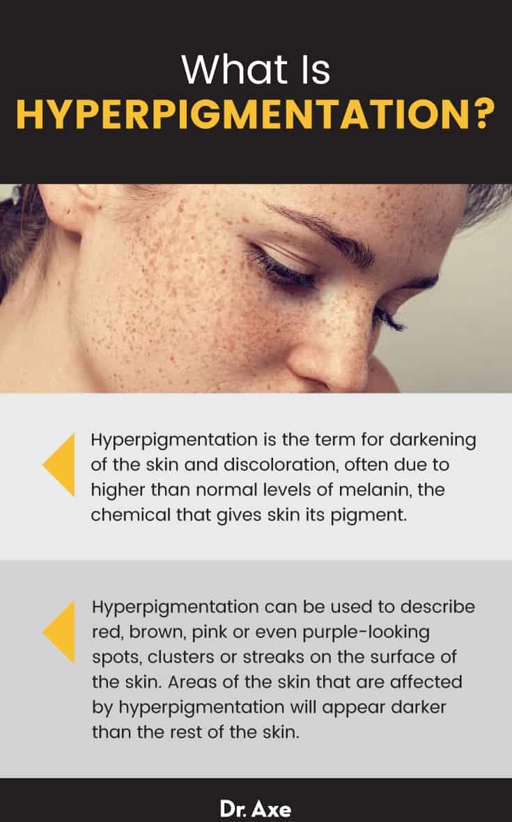 What is hyperpigmentation? - Dr. Axe