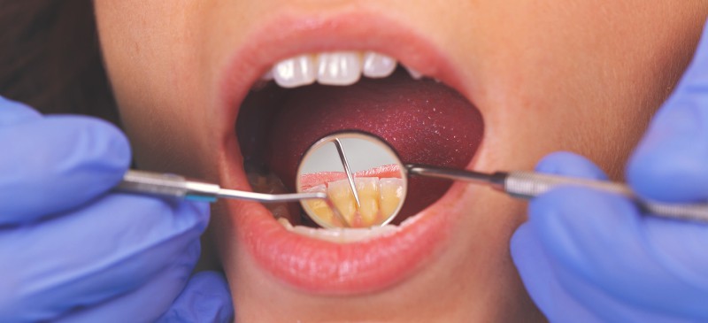 比牙龈炎更严重：牙周炎的原因和症状（+5种自然疗法）|苦荞之家