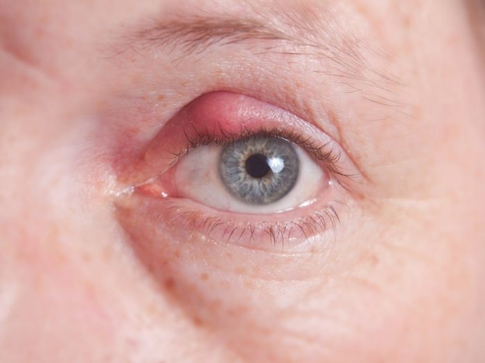 10种治疗眼部发炎的最佳家庭药方|苦荞之家